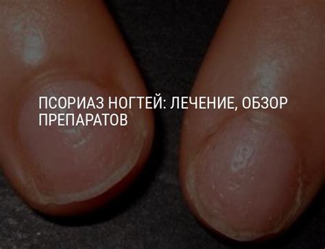 Псориаз ногтей на руках и ногах: лечение, средства при псориазе ногтей