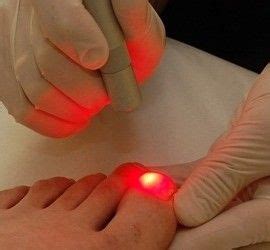 Toenail fungus laser treatment – Artofit