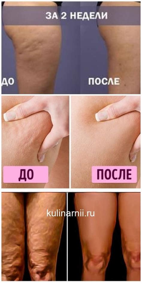 Целлюлит исчезнет волшебным образом! Древнее проверенное средство ...