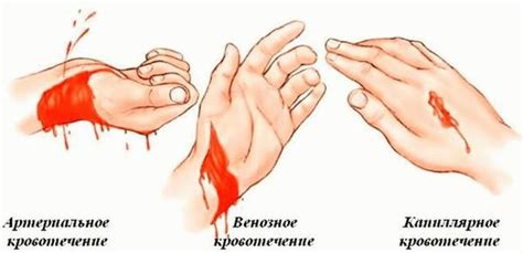 Види кровотеч і перша допомога при них - Це важливо знати кожному!