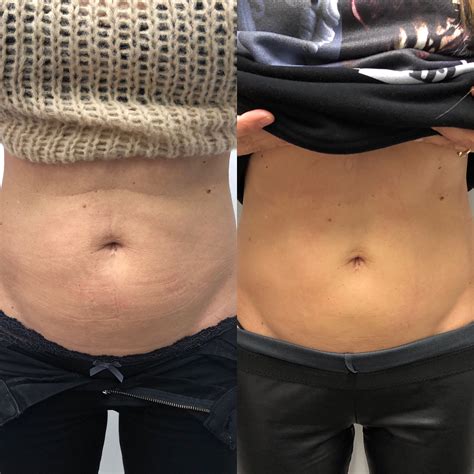 EmSchulpt-Behandlung-Bauch-Frau - Dr. Aesthetik