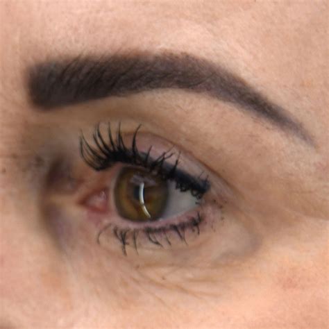 Eyelid Surgery Gallery for Halo Medical Services Portsmouth