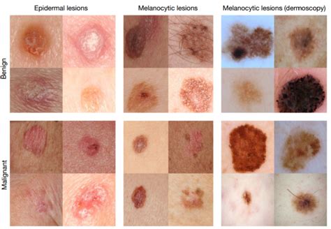 The Best 5 Skin Cancer On Scalp Photos - finalisitpics
