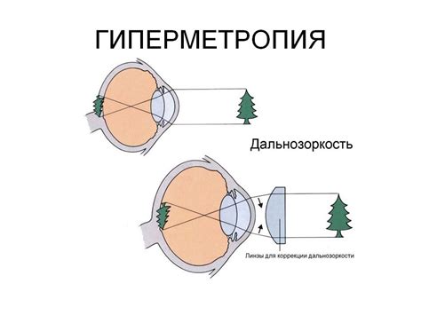 Гиперметропия глаз: степени, симптомы, лечение