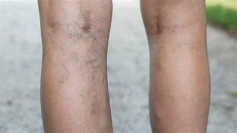 tak perlu suntik    meghilangkan varises  kaki secara alami