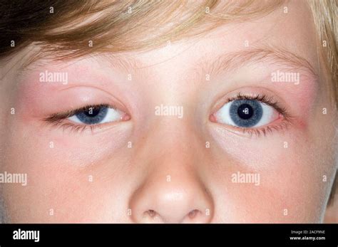 Insect bite allergy. Allergic reaction to an insect bite on the right ...