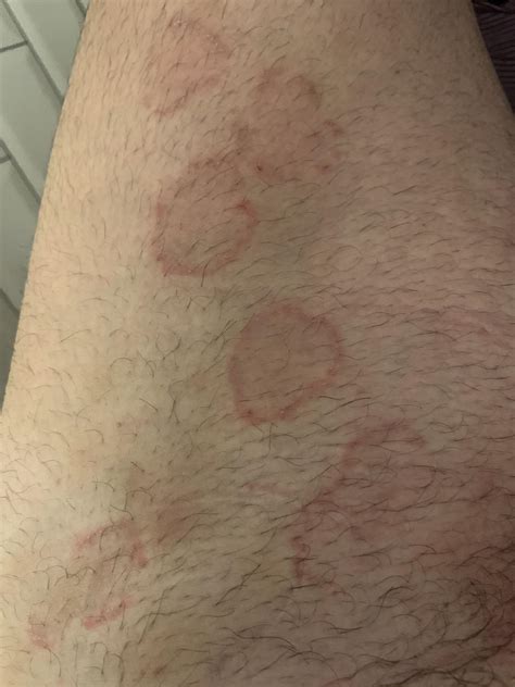 extremely itchy spots rdermatologyquestions
