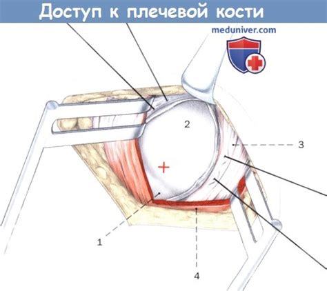 Техника проксимального доступа к плечевой кости