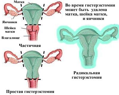 Удаление матки - гистерэктомия