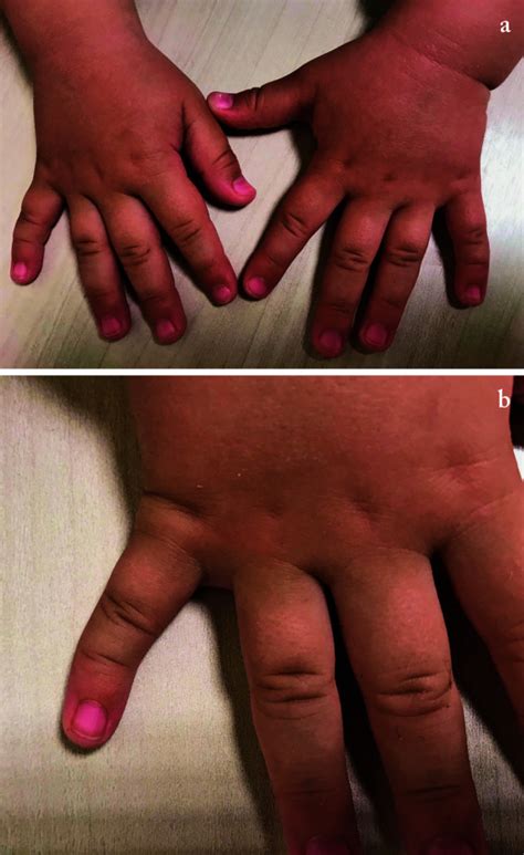 camptodactyly  clinodactyly  understanding   deformities