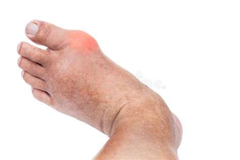 Dedo Do Pé Inchado Vermelho E Dolorido - Inchada, Deformada Articulação Inflamada Dos Dedos Do Pé Com Gota ...