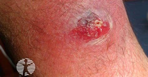 how to know if you have a boil