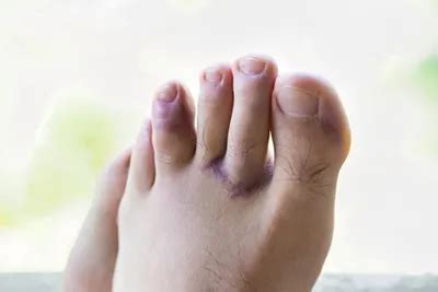 toe fractures podiatrist  wilmette il wilmette foot  ankle clinic