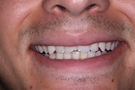 The Different Types of Chipped Tooth Repair Options