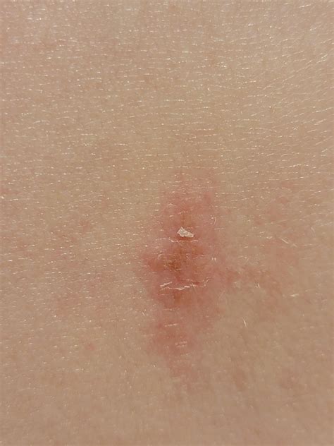 Amelanotic melanoma? I'm really scared. : r/Melanoma