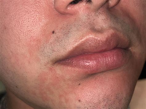face red blotches 7