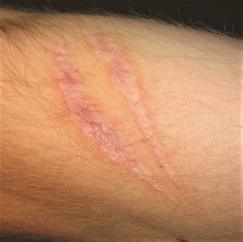 About Scars - Burn Survivor
