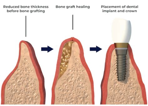 bone graft  existing teeth brighter dentist