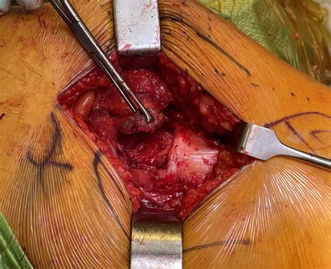 Abductor tendon tears | The Bone School