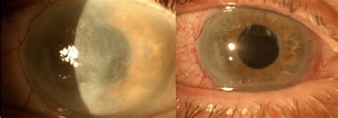 worlds leading expert  corneal scar correction dr gulani