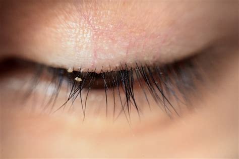 blepharitis  eyelash extensions tips relief corneacare
