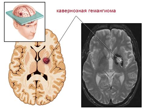 Гемангиома головного мозга: лечение, виды, симптомы и прогноз