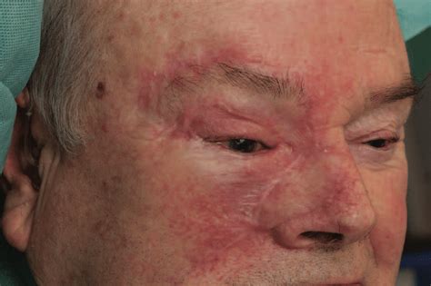 months post division   forehead flap  scientific