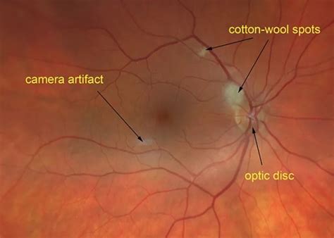 Cotton-Wool Spots - Scott E. Pautler, M.D. TampaScott E. Pautler, M.D ...