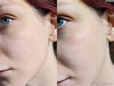Крем для лица ARAVIA успокаивающий с ниацинамидом Acne balance SPF 20 ...