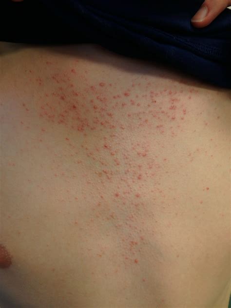 Acne Variants: Conglobata, Fulminans, and Medication-induced – Pediatric Dermatology