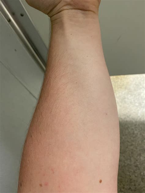 Swollen right arm? Atrophy? What is it? : r/MuscleTwitch