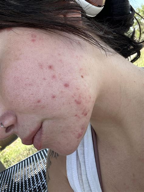 Does iPhone camera make skin look worse? : r/Spironolactone