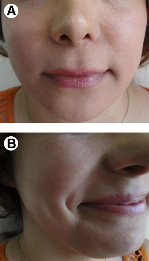 Why Do I Have Dimples Under My Lips | Lipstutorial.org