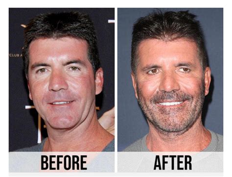 Simon Cowell Plastic Surgery: Unveiling the Impact of Cosmetic Enhancement