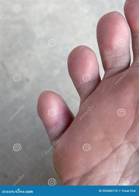 Bruised Pinky Toe Injured by a Dropped Smartphone Stock Photo - Image