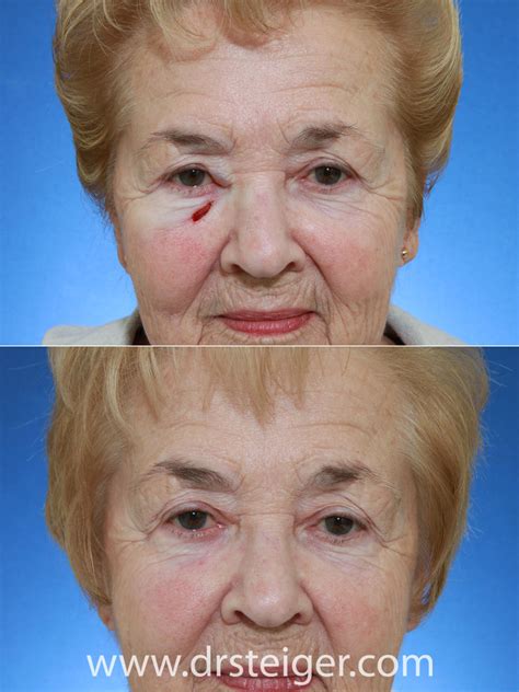 MOHS Surgery Reconstruction Before and After Photos