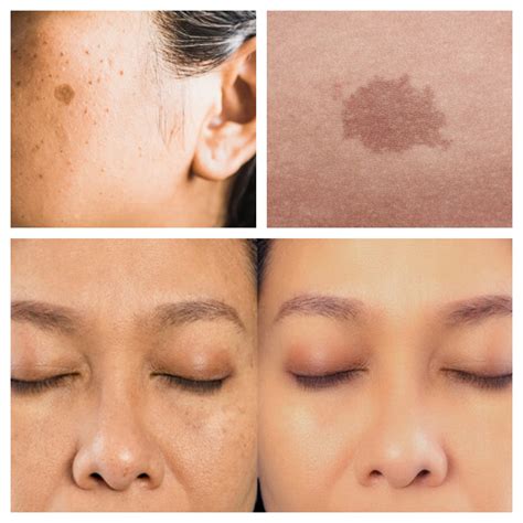 Empowering Beauty with Skin Pigmentation Solutions - Ethel Da Costa