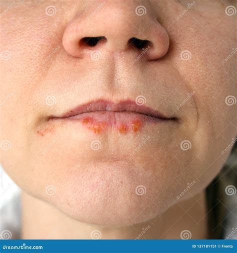 Acd Az Of Skin Herpes Labialis