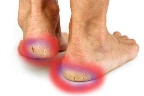 cracked feet   natural home remedies