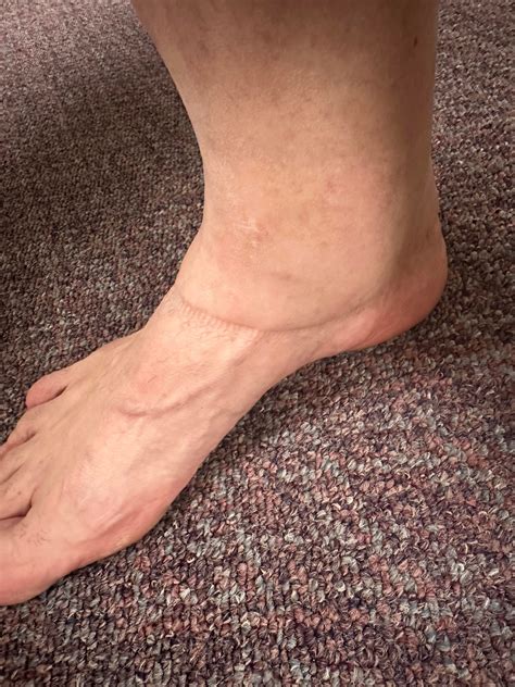 Can this be a sign of sarcoidosis pictures of severe swelling in my