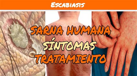 Sarna Humana
