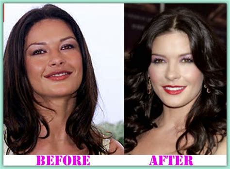Surgery Plastic Before After: Catherine Zeta Jones Plastic Surgery ...