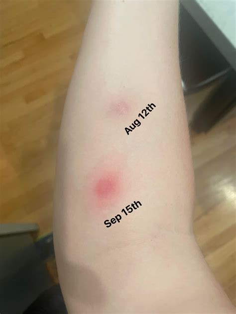 Monkeypox dose 1 & 2. Hoping these things eventually clear up. The