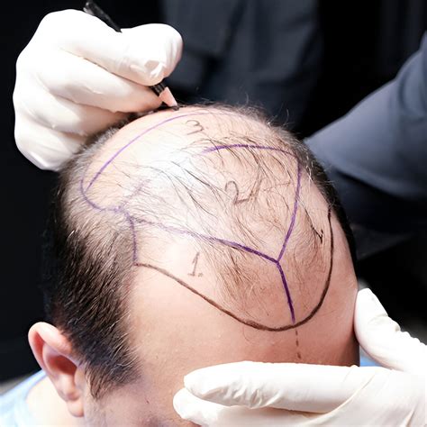 hair transplant  jaipur qht clinic natural results