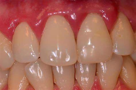 Запалення ясен ️ Лікування запалення ясен в Ірпені | MySmile®