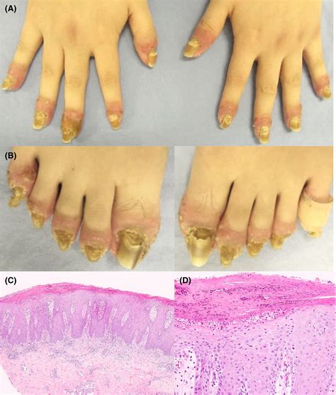 Acrodermatitis continua of Hallopeau successfully treated only with