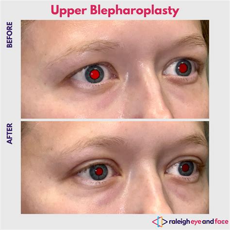 Top Rated Upper Eyelid Surgery Before And After Gallery — Raleigh Eye