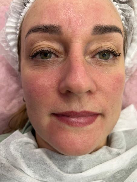 Щечки яблочки Одна из самых КРУТЕЙШИХ ПРОЦЕДУР, когда результат видно ...