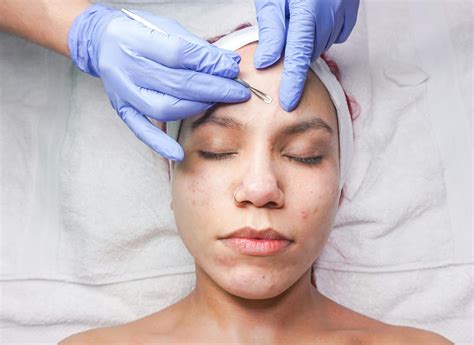 Expert Advice on Acne Scarring Treatment Methods - Howharddoyousparkle.com
