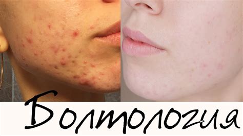 Как я вылечила кожу? Акне. Жирная кожа. Кислотная косметика. La Roche ...